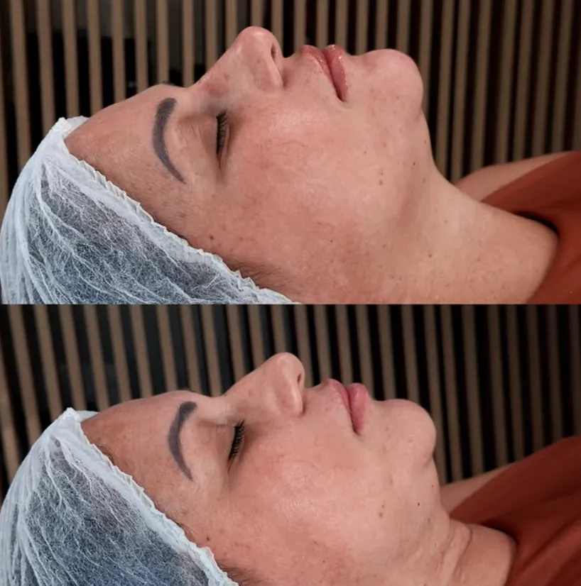 Comparação de perfil antes e depois de procedimento facial no Instituto Dal Prá